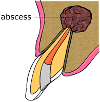 abscess
