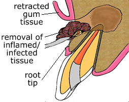 removal